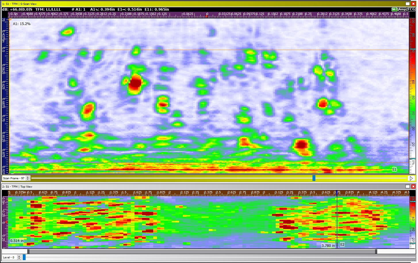 Stage 3 HTHA from the same TFMi Scan as above